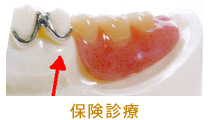 入れ歯の保険と自費の違い